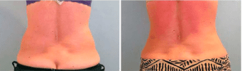 Before and After CoolSculpting®
