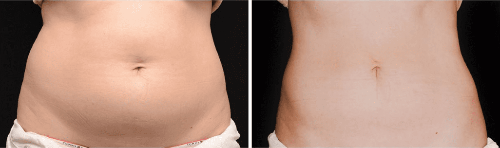 before-and-after-coolsculpting