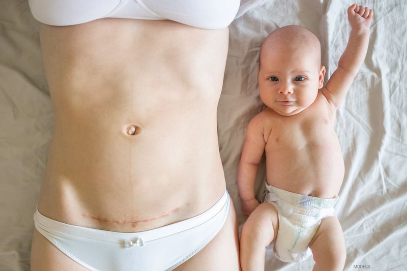 A woman in a white bra and underwear with a c-section scar lays next to her infant.