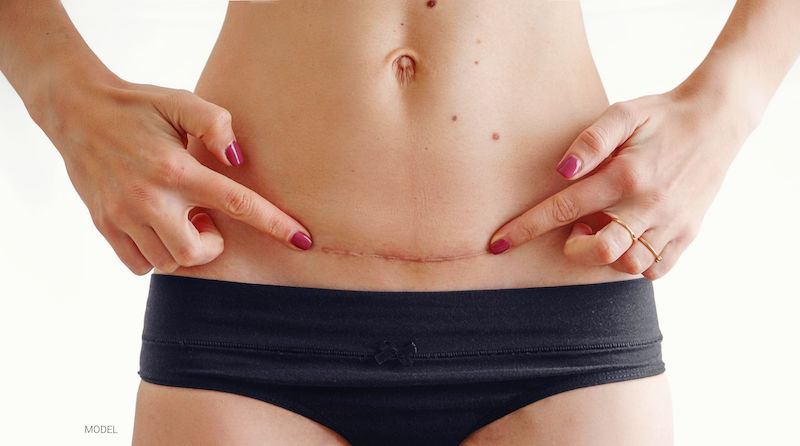 Closeup of woman belly with a scar from a cesarean section size isolated