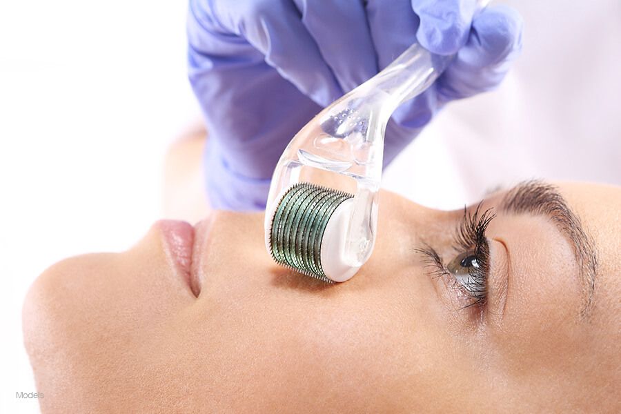 Side closeup of a woman's face getting a microneedling treatment from a gloved hand with her eyes open.